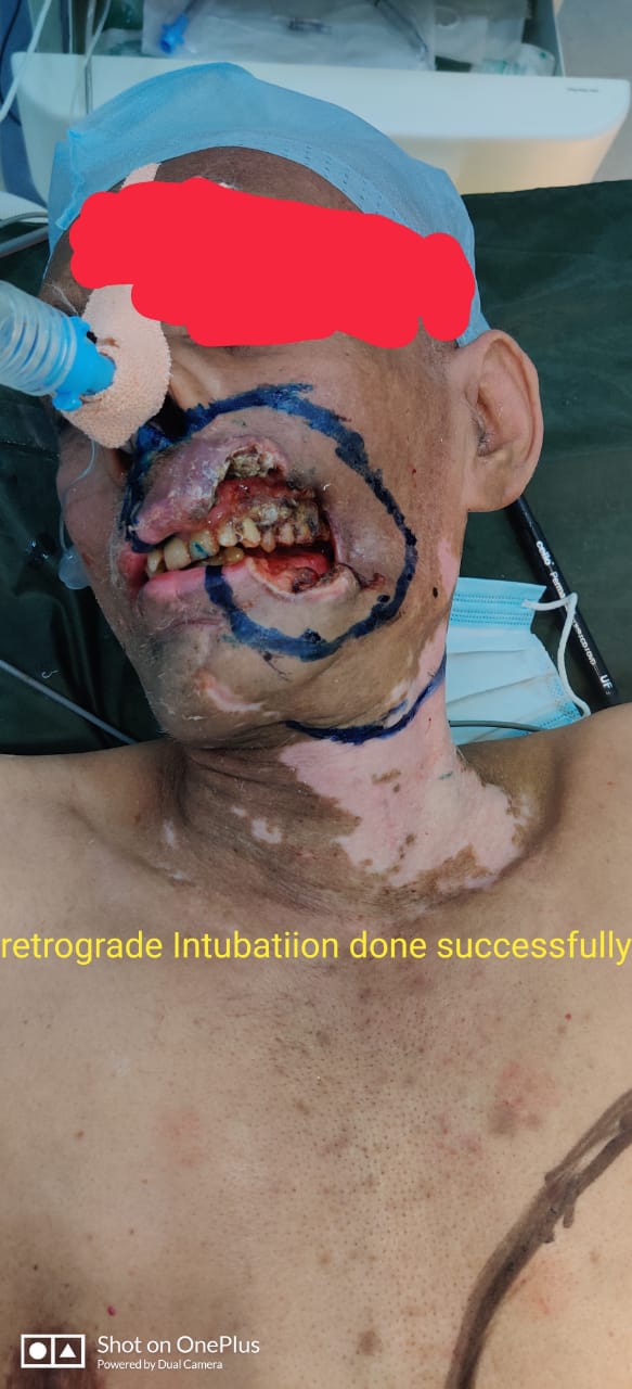 Retrograde Intubation Technique - Cover Image